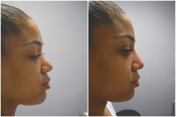 Before and After Image: Non-Surgical Rhinoplasty - right-side