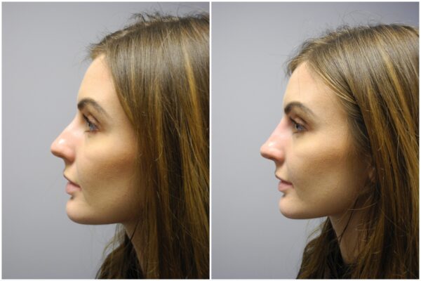 Before and After Image: Non-Surgical Rhinoplasty - left-side