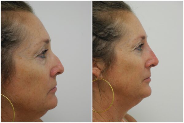 Before and After Image: Non-Surgical Rhinoplasty - right-side