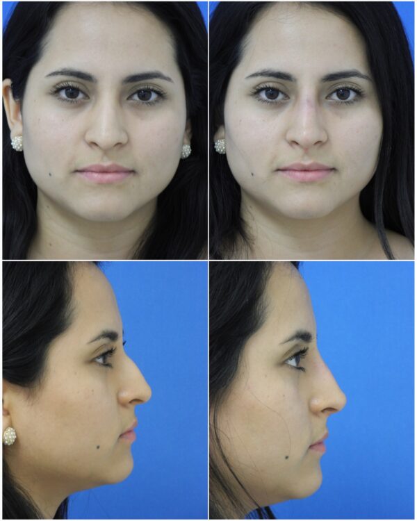 Before and After Image: Non-Surgical Rhinoplasty - other