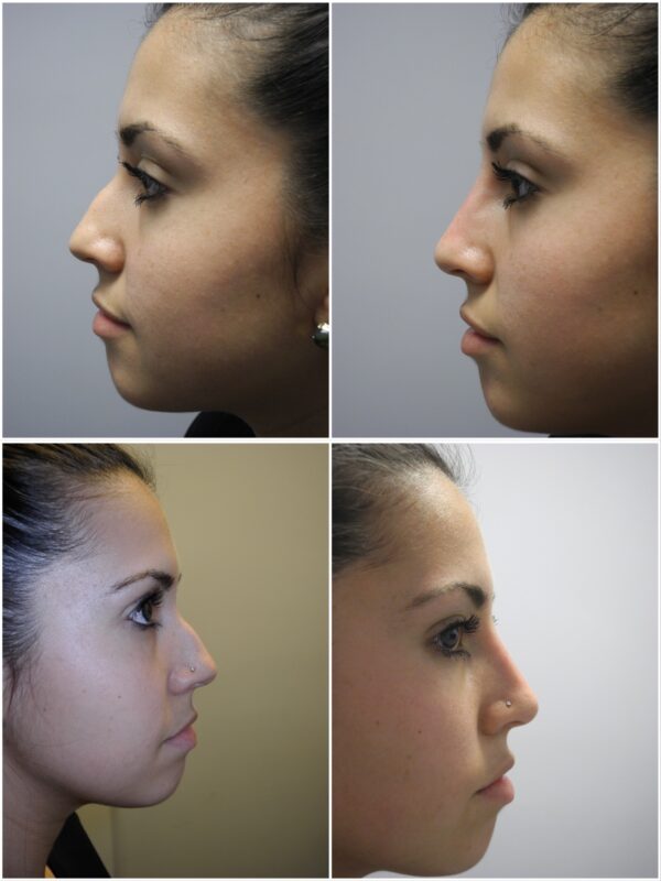 Before and After Image: Non-Surgical Rhinoplasty - other