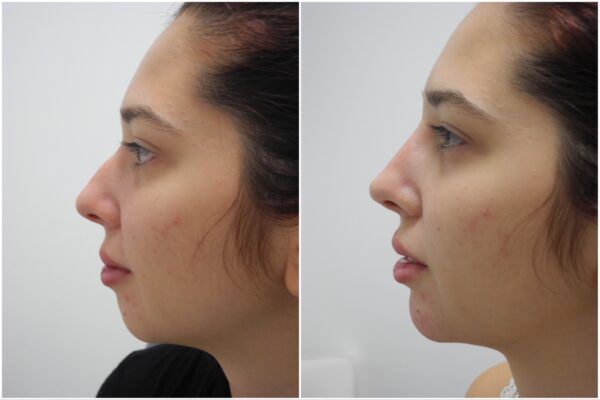 Before and After Image: Non-Surgical Rhinoplasty - left-side