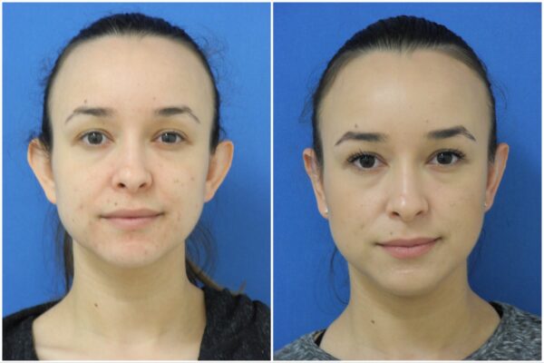 Before and After Image: Ear Surgery (Otoplasty) - front