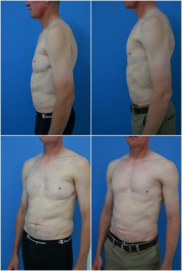 Before and After Image: Male Pec Implant - other
