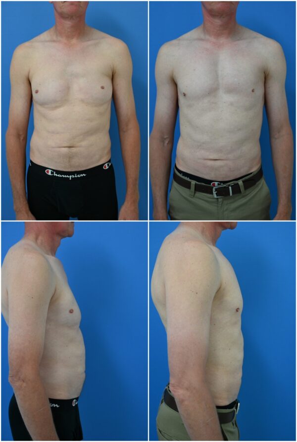 Before and After Image: Male Pec Implant - other