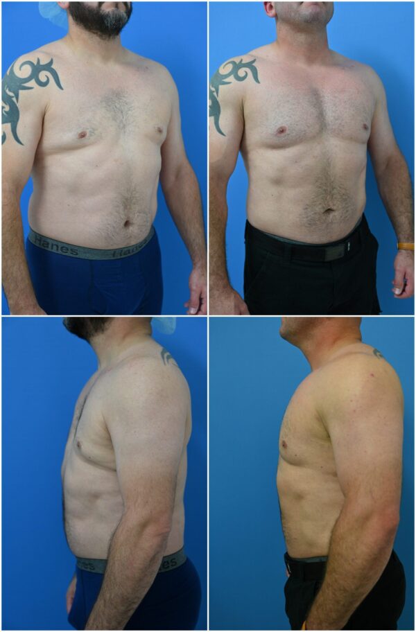 Before and After Image: Male Pec Implant - other