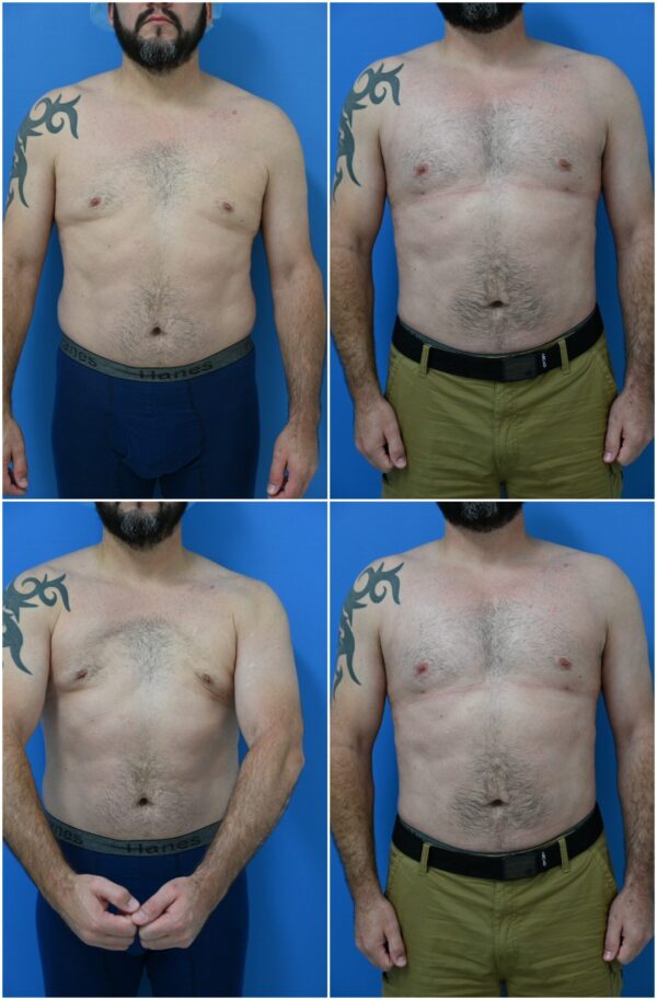 Before and After Image: Male Pec Implant - other