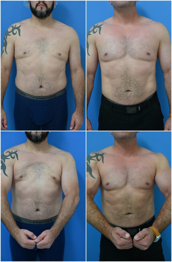 Before and After Image: Male Pec Implant - other