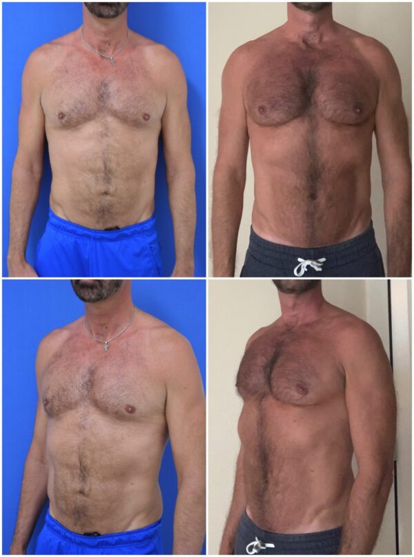 Before and After Image: Male Pec Implant - other