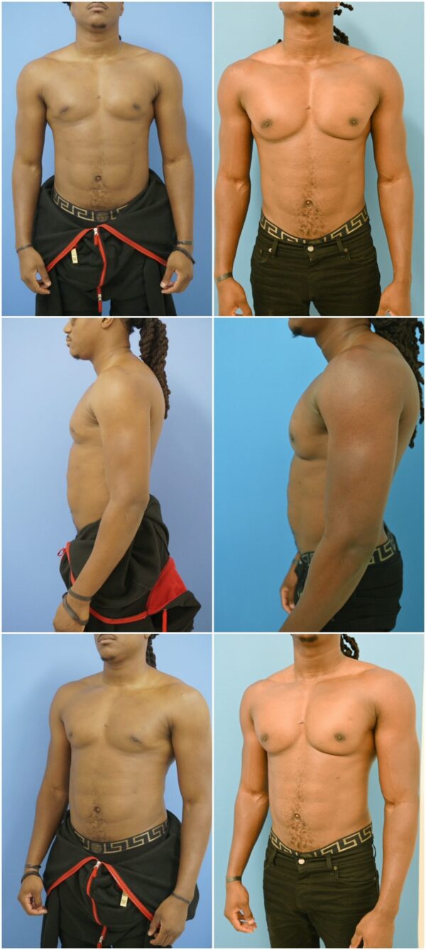 Before and After Image: Male Pec Implant - other