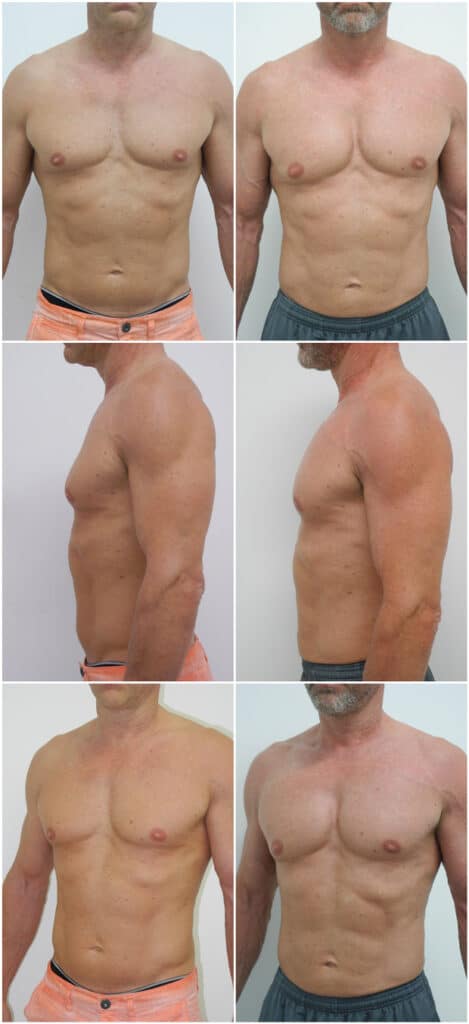Before and After Image: Male Pec Implant - other