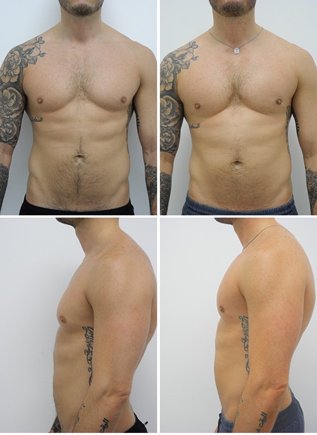 Before and After Image: Male Pec Implant - other
