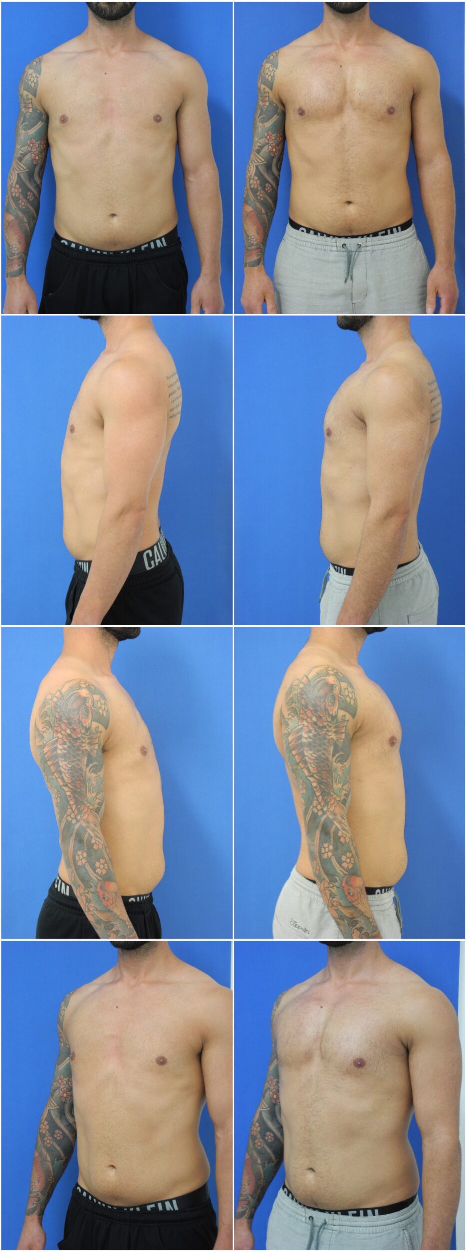 Before and After Image: Male Pec Implant - other