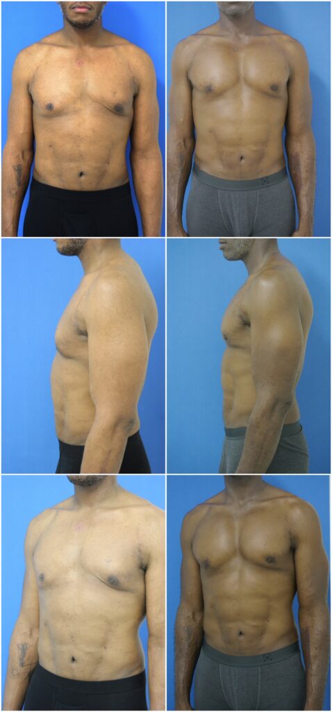 Before and After Image: Male Pec Implant - other