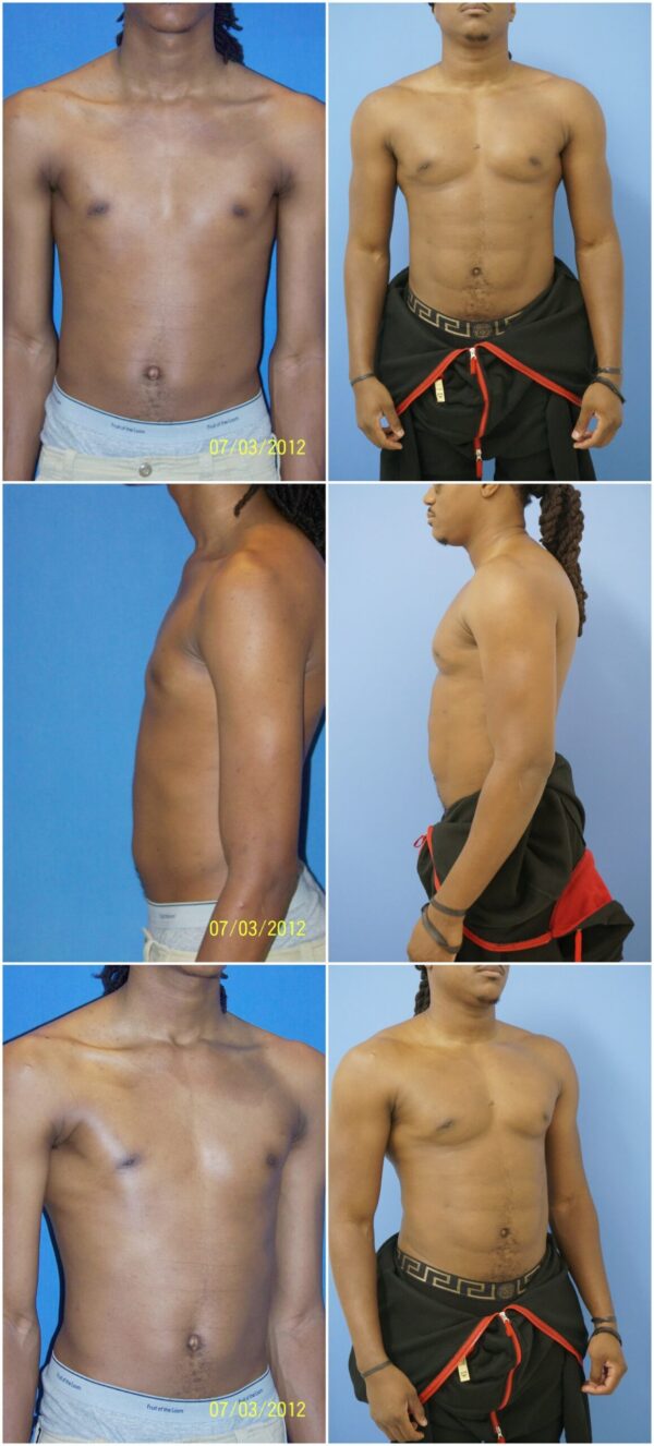 Before and After Image: Male Pec Implant - other