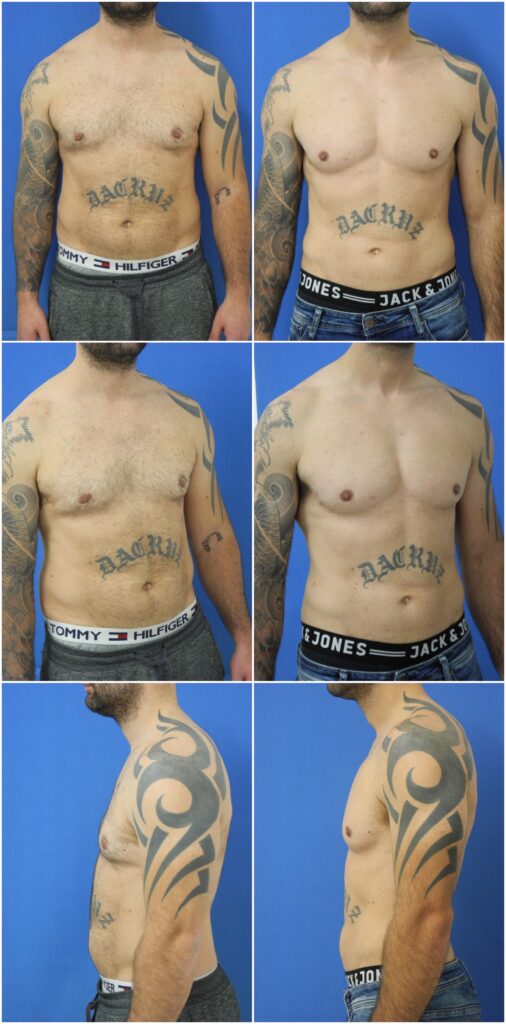 Before and After Image: Male Pec Implant - other