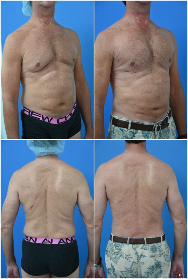 Before and After Image: Gynecomastia Correction - other