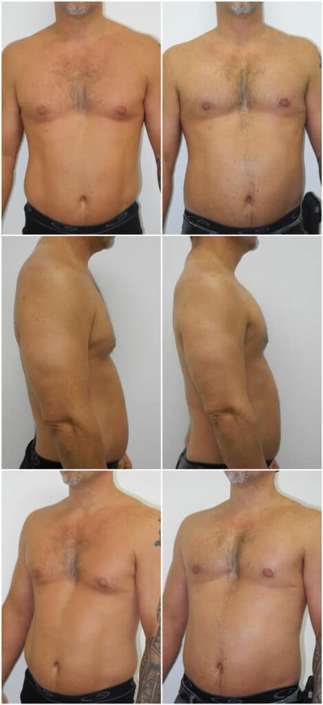 Before and After Image: Gynecomastia Correction - other