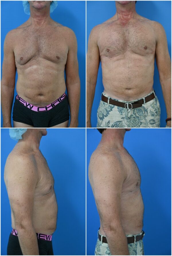 Before and After Image: Male Pec Implant - other