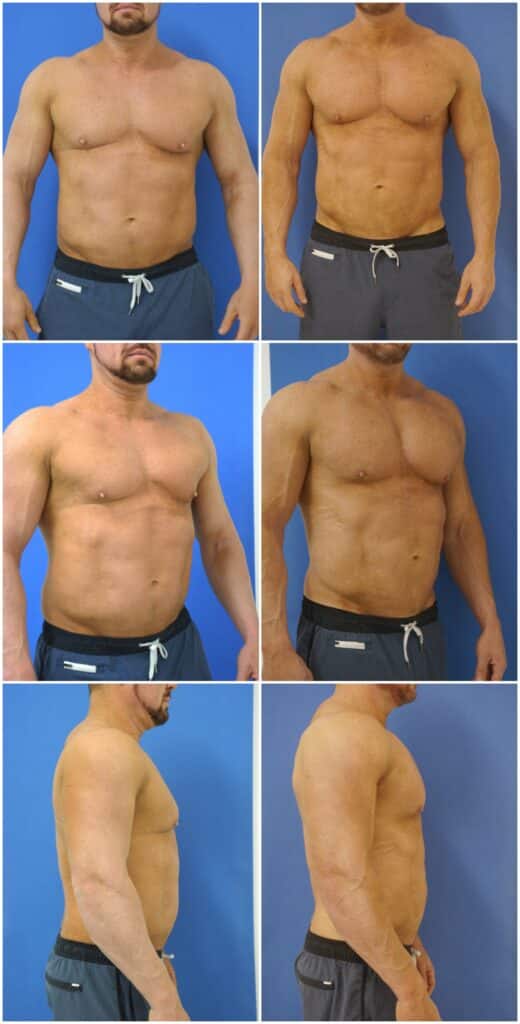 Before and After Image: Male Pec Implant - other