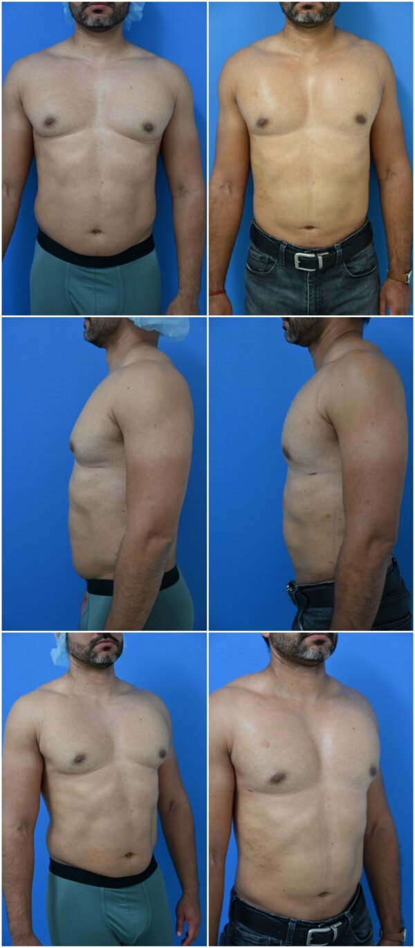 Before and After Image: Male Pec Implant - other