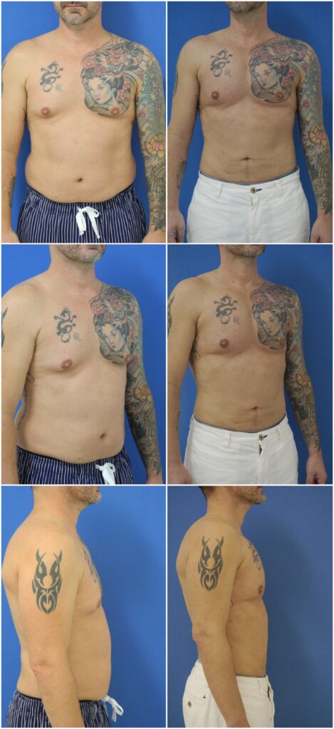 Before and After Image: Male Pec Implant - other