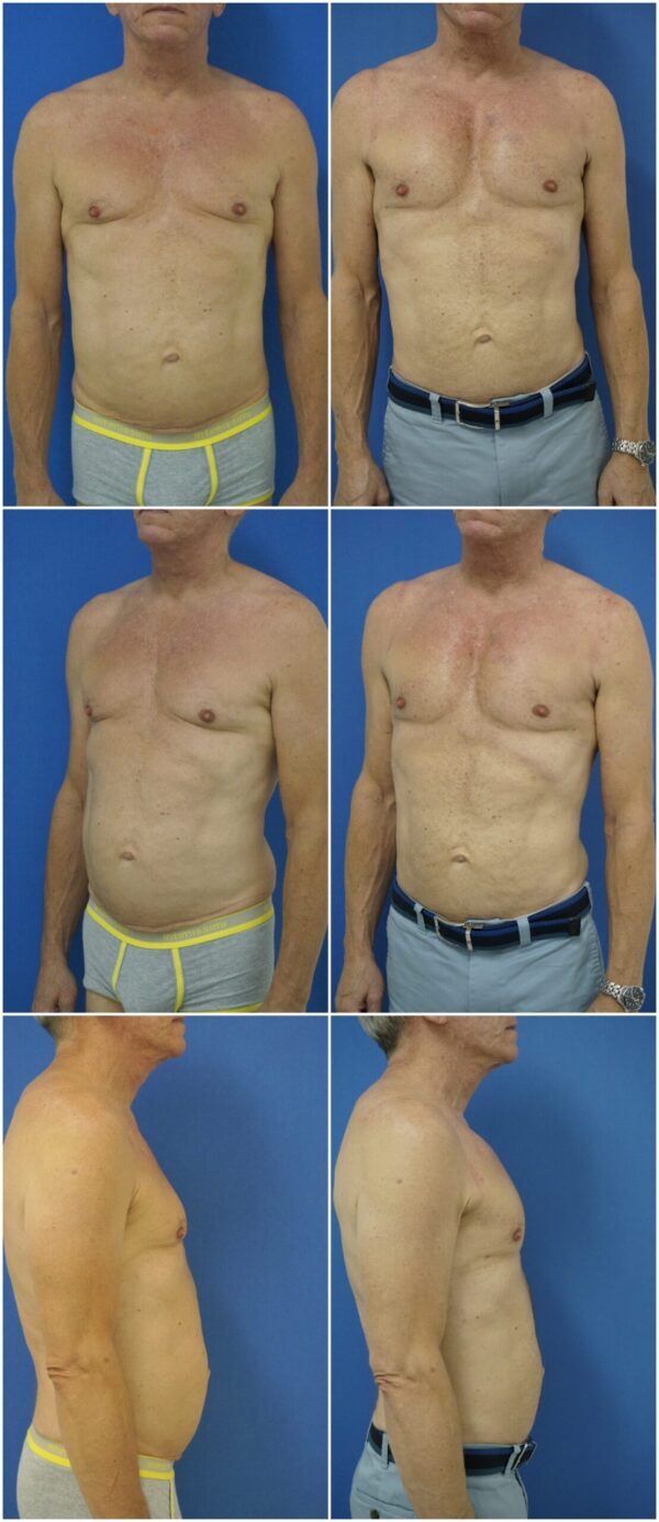 Before and After Image: Male Pec Implant - other
