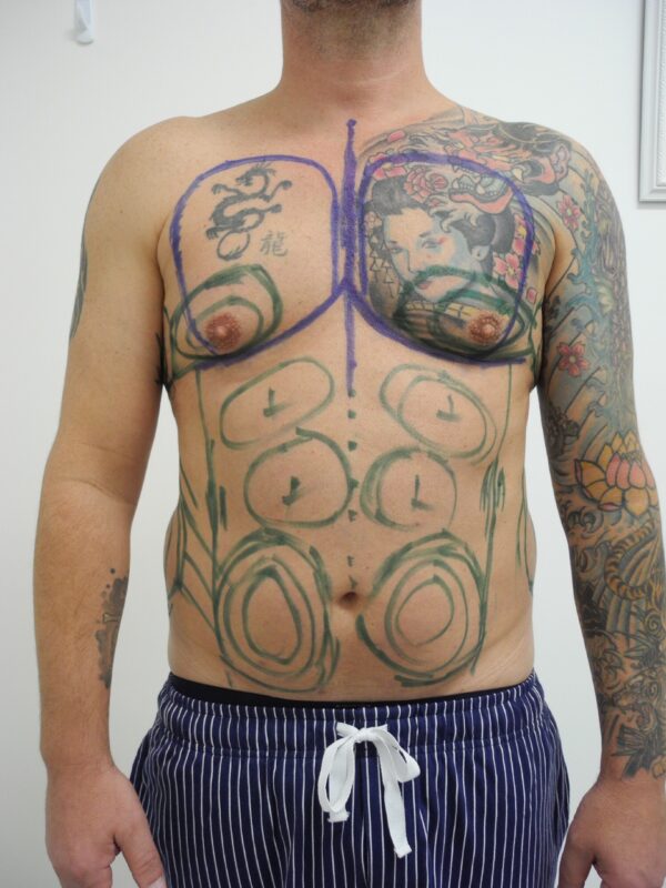 Before and After Image: Gynecomastia Correction - other