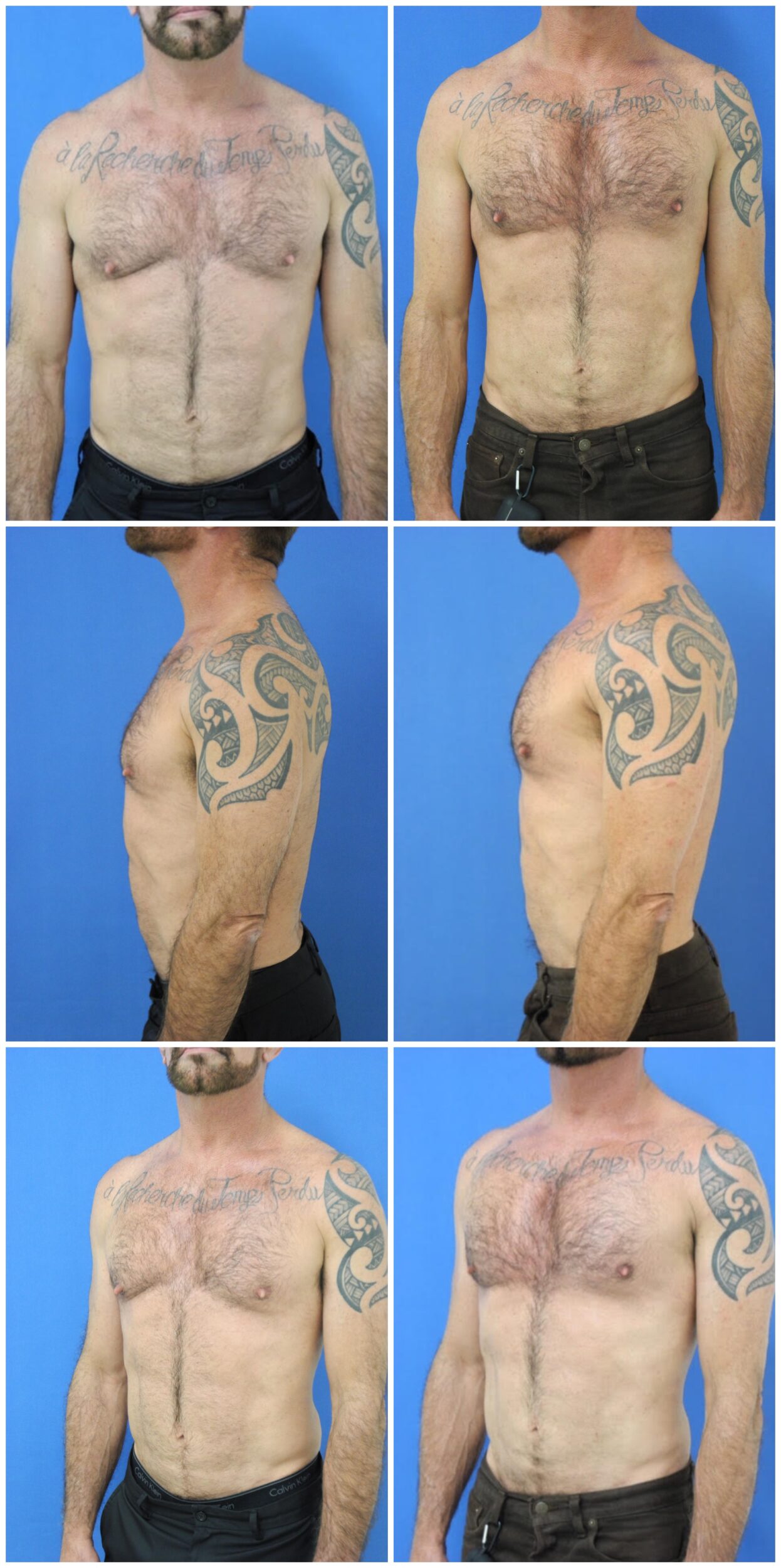 Before and After Image: Male Pec Implant - other