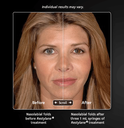 Restylane1 Dr. Gershenbaum Dermal Facial Fillers in Miami, FL