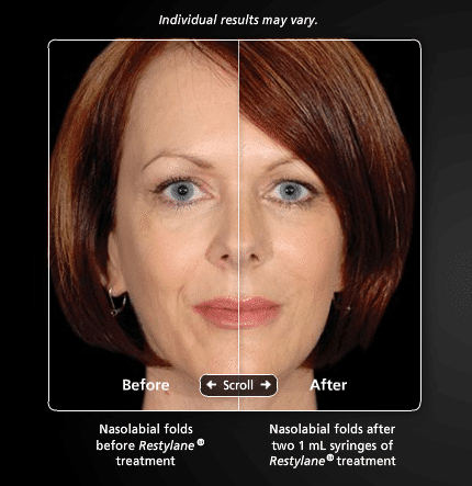 Restylane2 Dr. Gershenbaum 430x443 1 Dermal Facial Fillers in Miami, FL