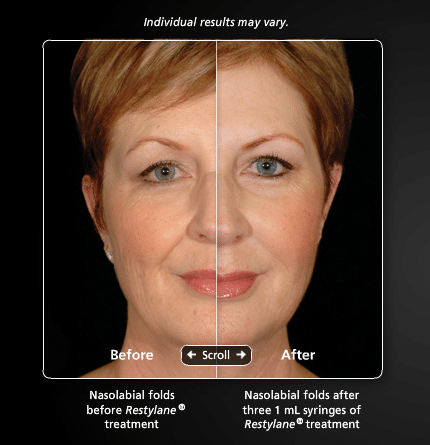 Restylane3 Dr. Gershenbaum 430x445 1 Dermal Facial Fillers in Miami, FL