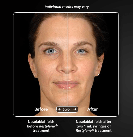 Restylane4 Dr. Gershenbaum 430x445 1 Dermal Facial Fillers in Miami, FL