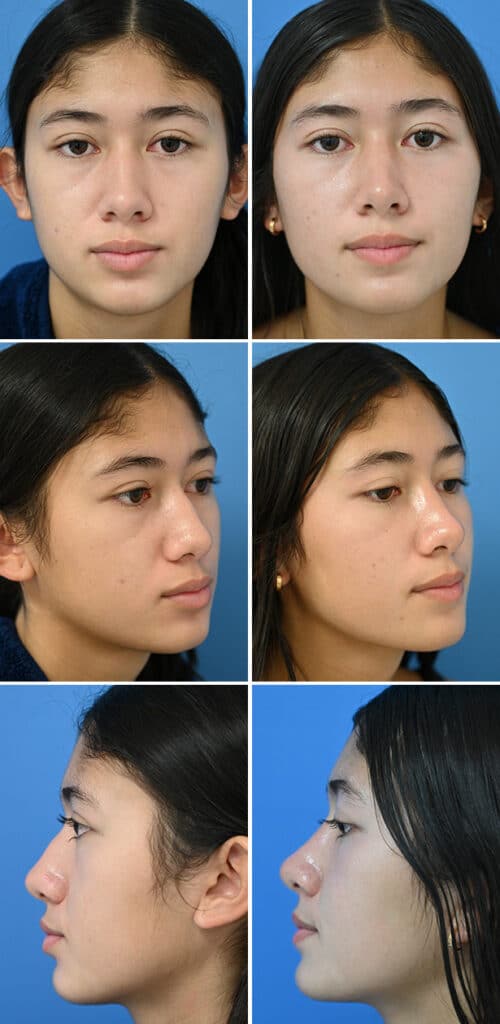 Before and After Image: Rhinoplasty - other