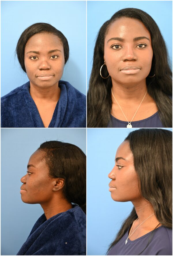 Before and After Image: Rhinoplasty - other