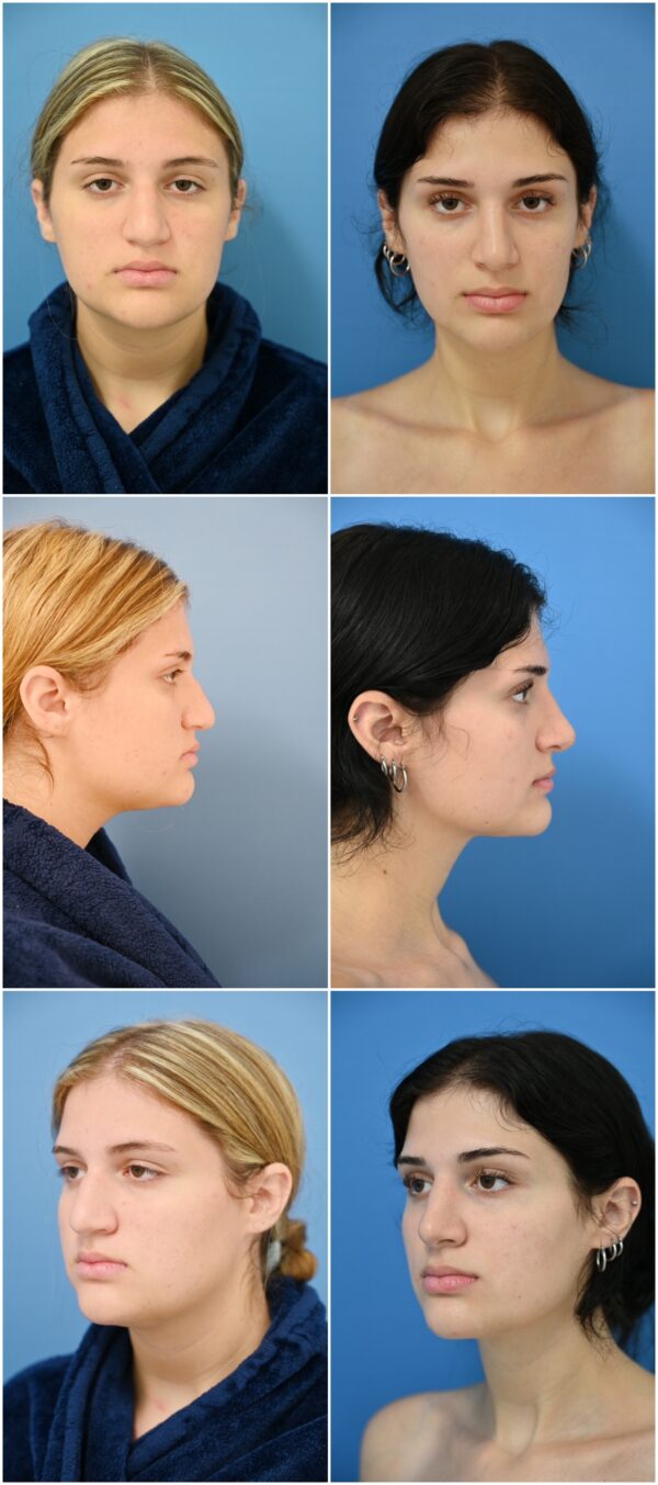 Before and After Image: Rhinoplasty - other