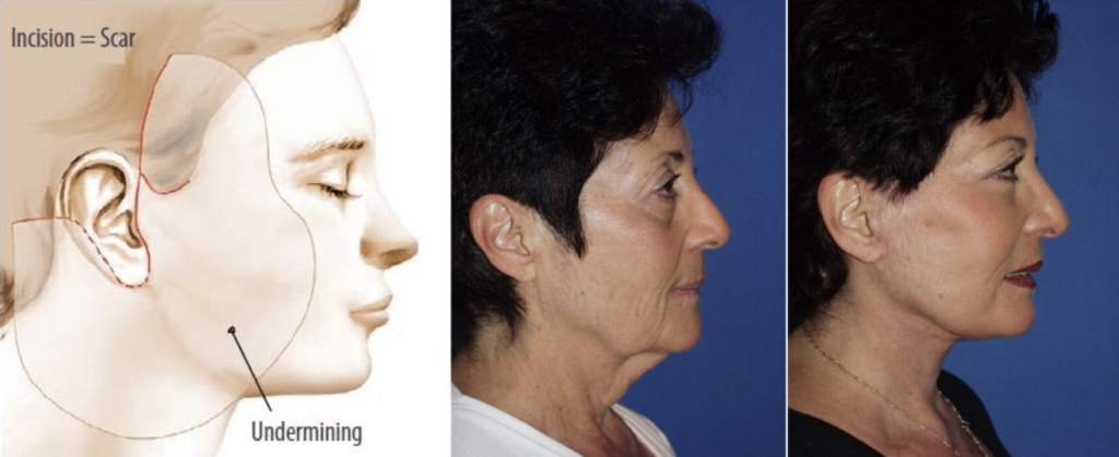 Screenshot 2025 12 18 at 10.28.00 AM Facelift in Miami, FL