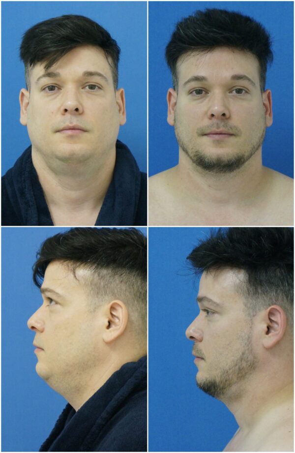 Before and After Image: Neck Liposuction Surgery - other