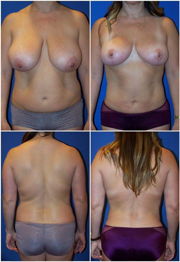 Before and After Image: Liposuction / Liposculpture Surgery - other
