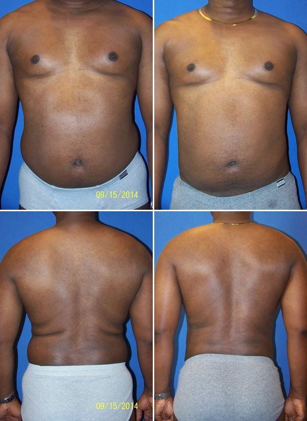Before and After Image: Liposuction / Liposculpture Surgery - other