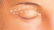 bleph incision 02 Cosmetic Eyelid Surgery in Miami, FL