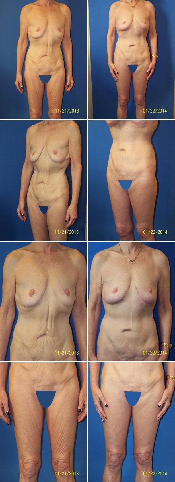 Before and After Image: Tummy Tuck (Abdominoplasty) - other