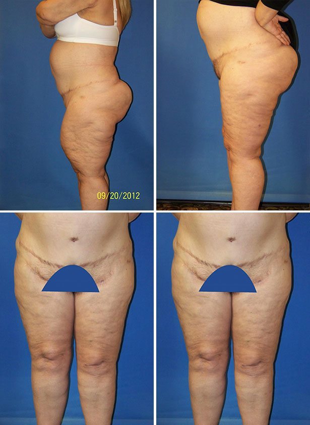 Before and After Image: Body Lift - other