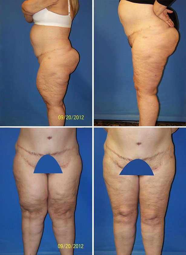 Before and After Image: Thigh Lift - other