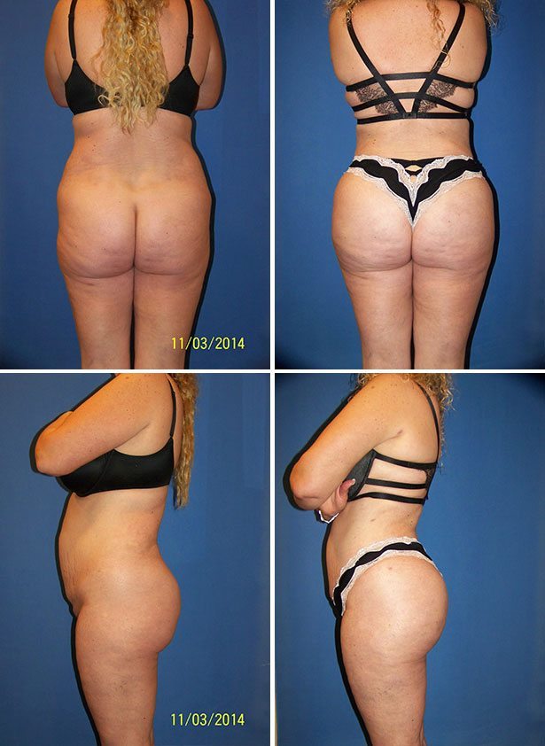 Before and After Image: Butt Augmentation (Implants) - other