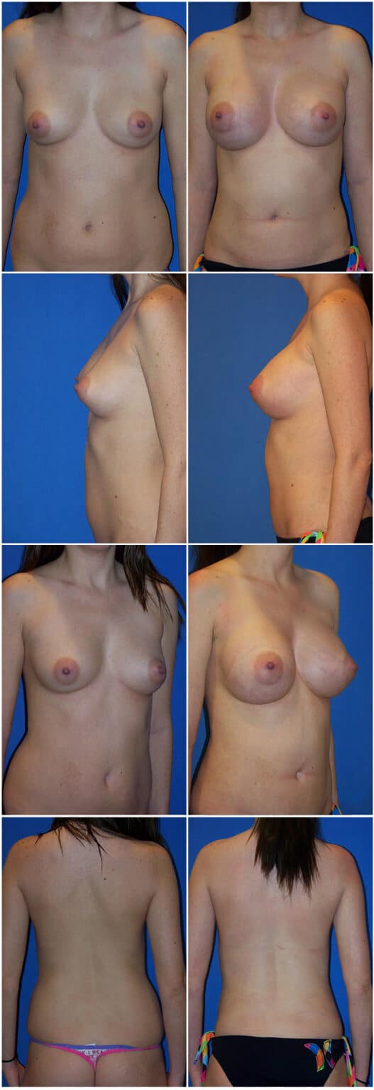 Before and After Image: Breast Augmentation - other
