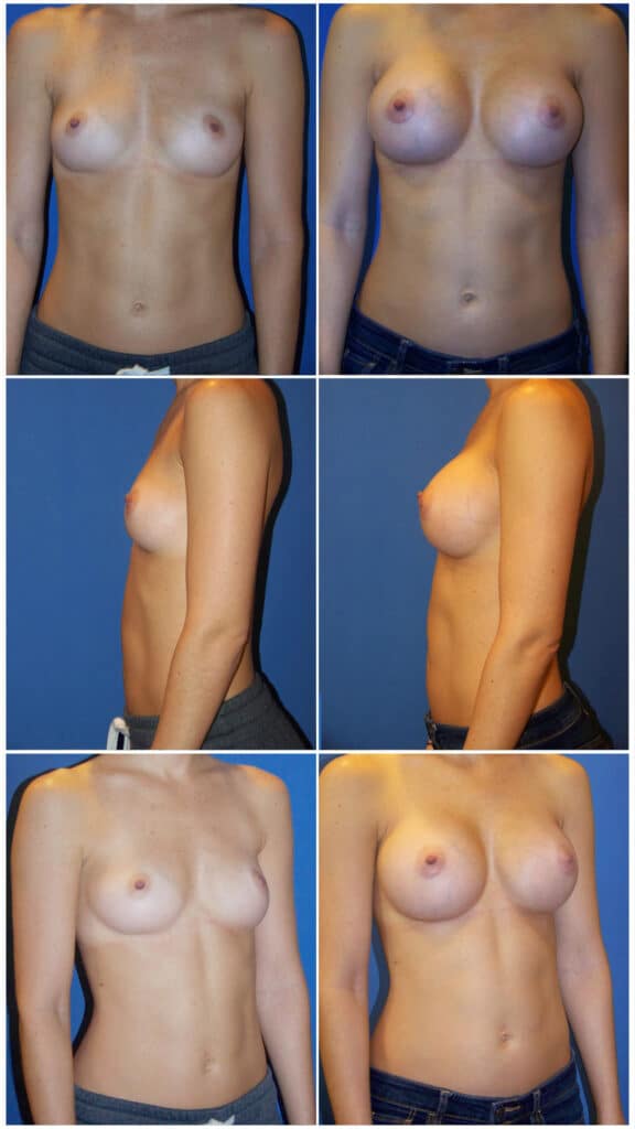 Before and After Image: Breast Augmentation - other