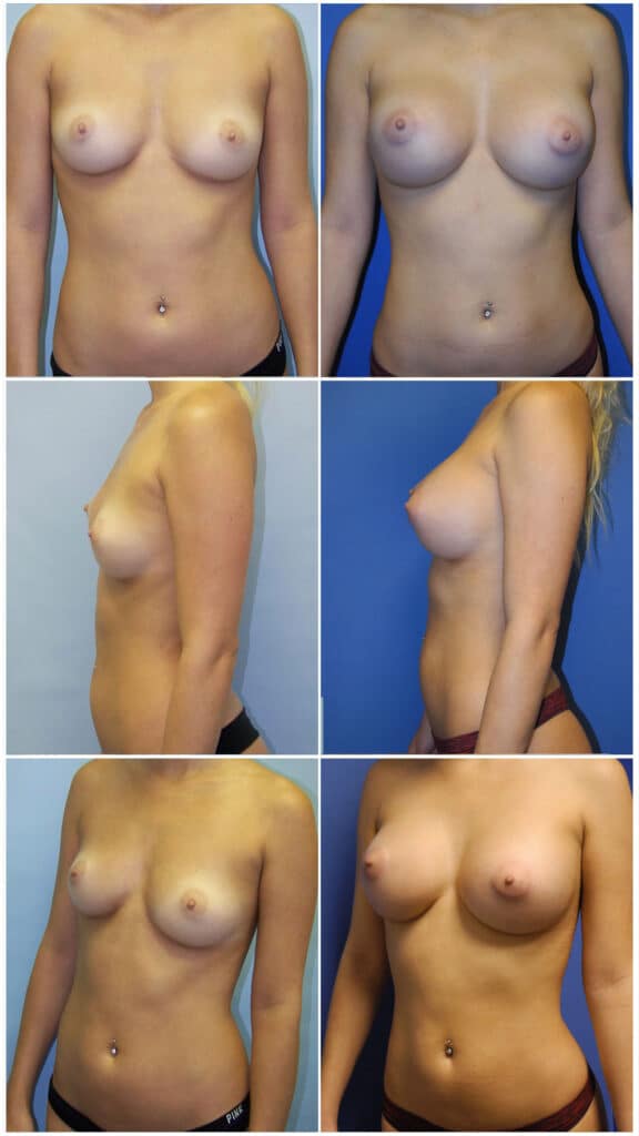 Before and After Image: Breast Augmentation - other