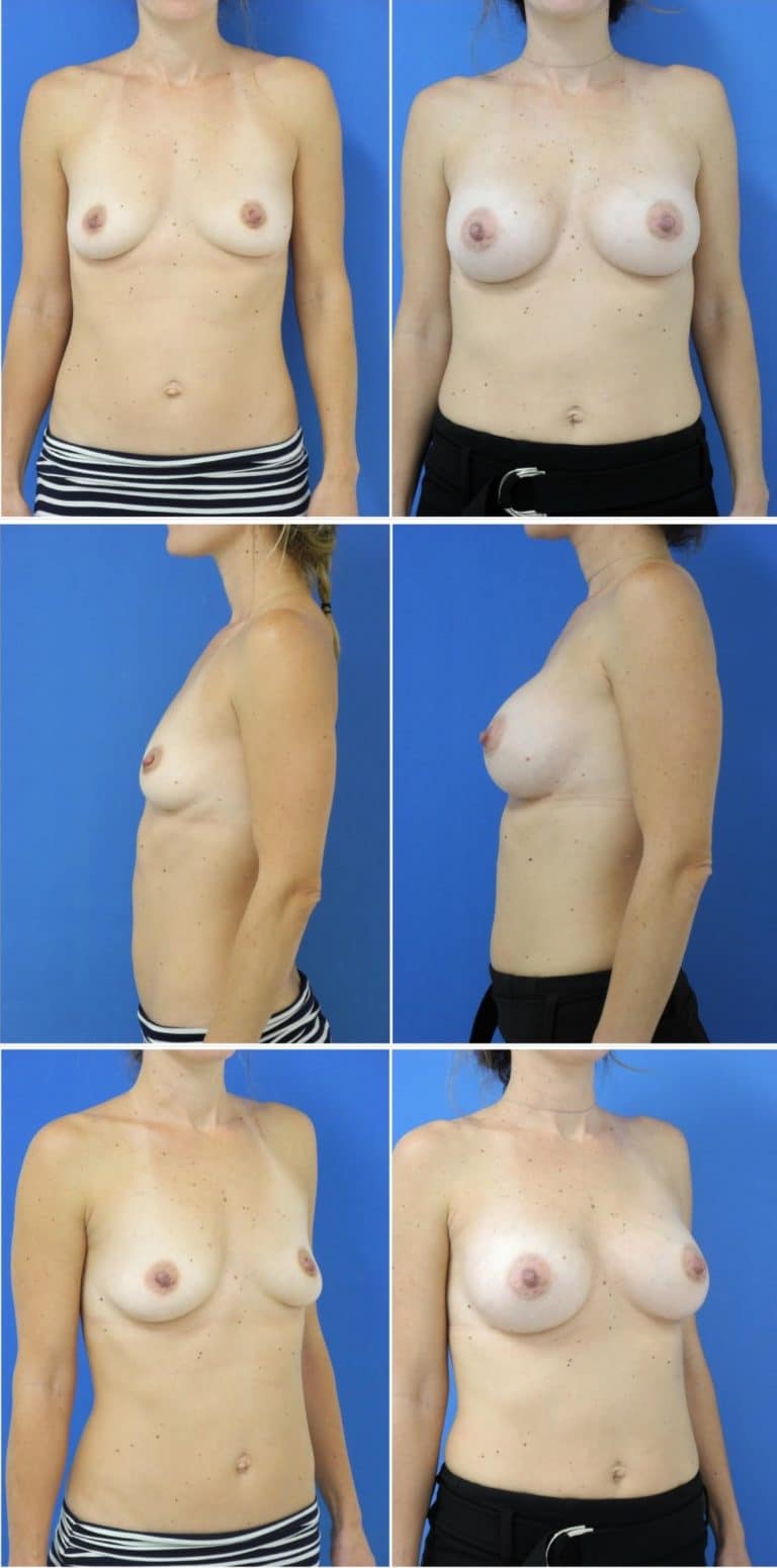 Before and After Image: Breast Augmentation - other