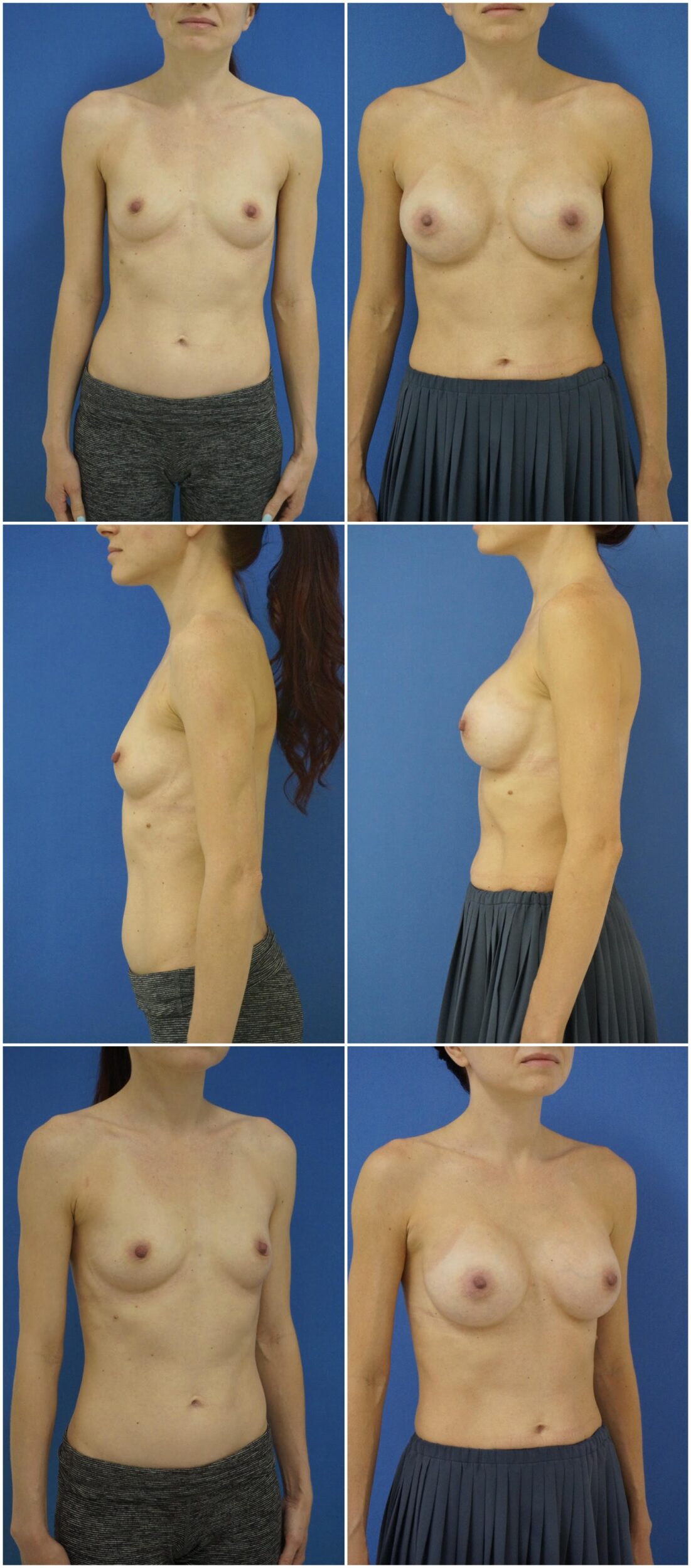 Before and After Image: Breast Augmentation - other